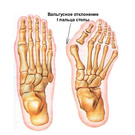 Операция на ступню