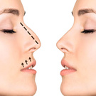 Rhinoplasty