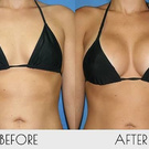 breast augmentation surgery