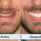 blanqueamiento de dientes
