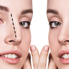 RHINOPLASTY