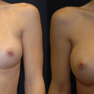 BREAST AUGMENTATION