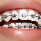 braces